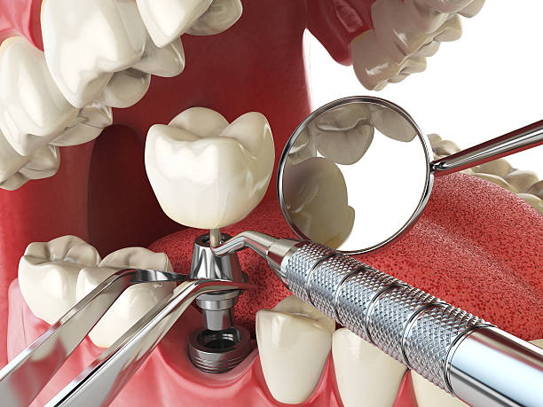 Best Emergency Denture Repair in Newberry, MI